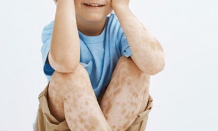 Vitiligo – Warum der adjuvante Einsatz von Antioxidantien sinnvoll ist